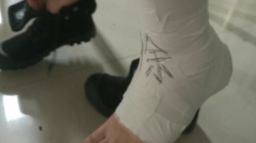 崴脚的急性处理